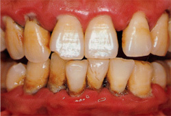 重度歯周炎の歯肉