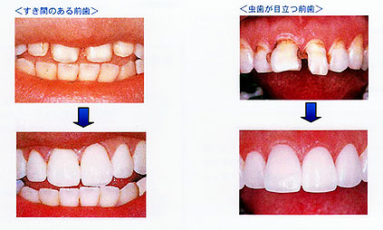 セラミックによる歯並びの治療法